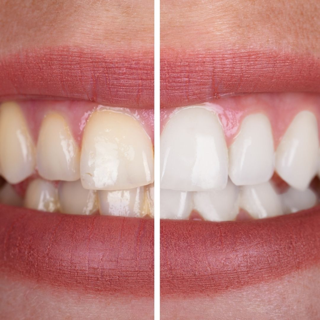 Before and after comparison of teeth with a dental crown.