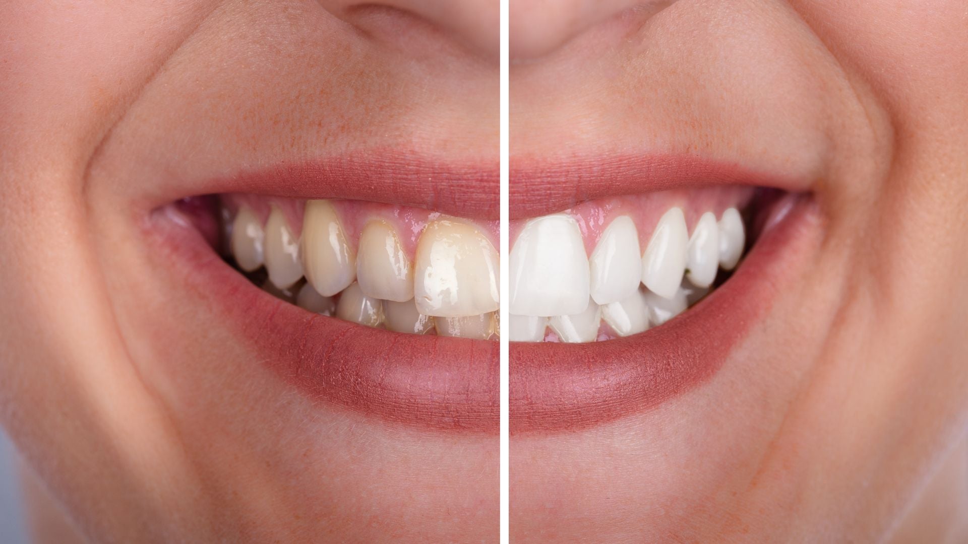 Whitening before and after smile - PAP+ whitening drops